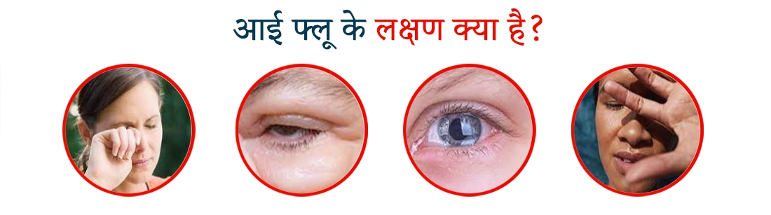 Symtomes of Eye flu in Hindi
